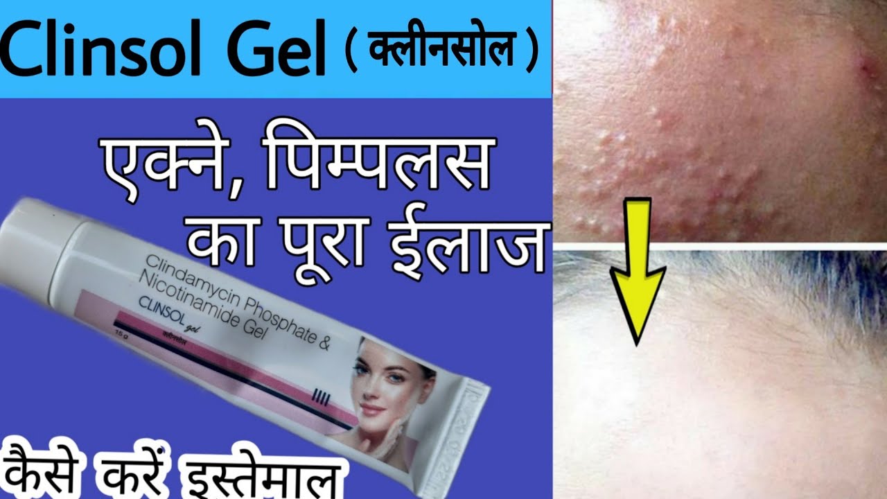 Clinsol Gel Use In Hindi
